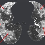What Does Ground Glass Opacity In Lungs Mean